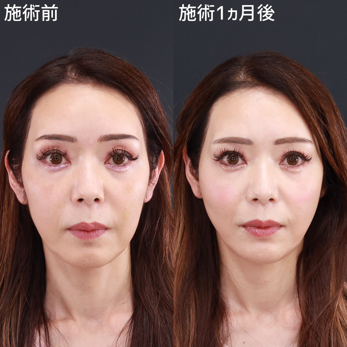 【小顔整形】糸リフトでぱっと明るく若々しい印象へ！