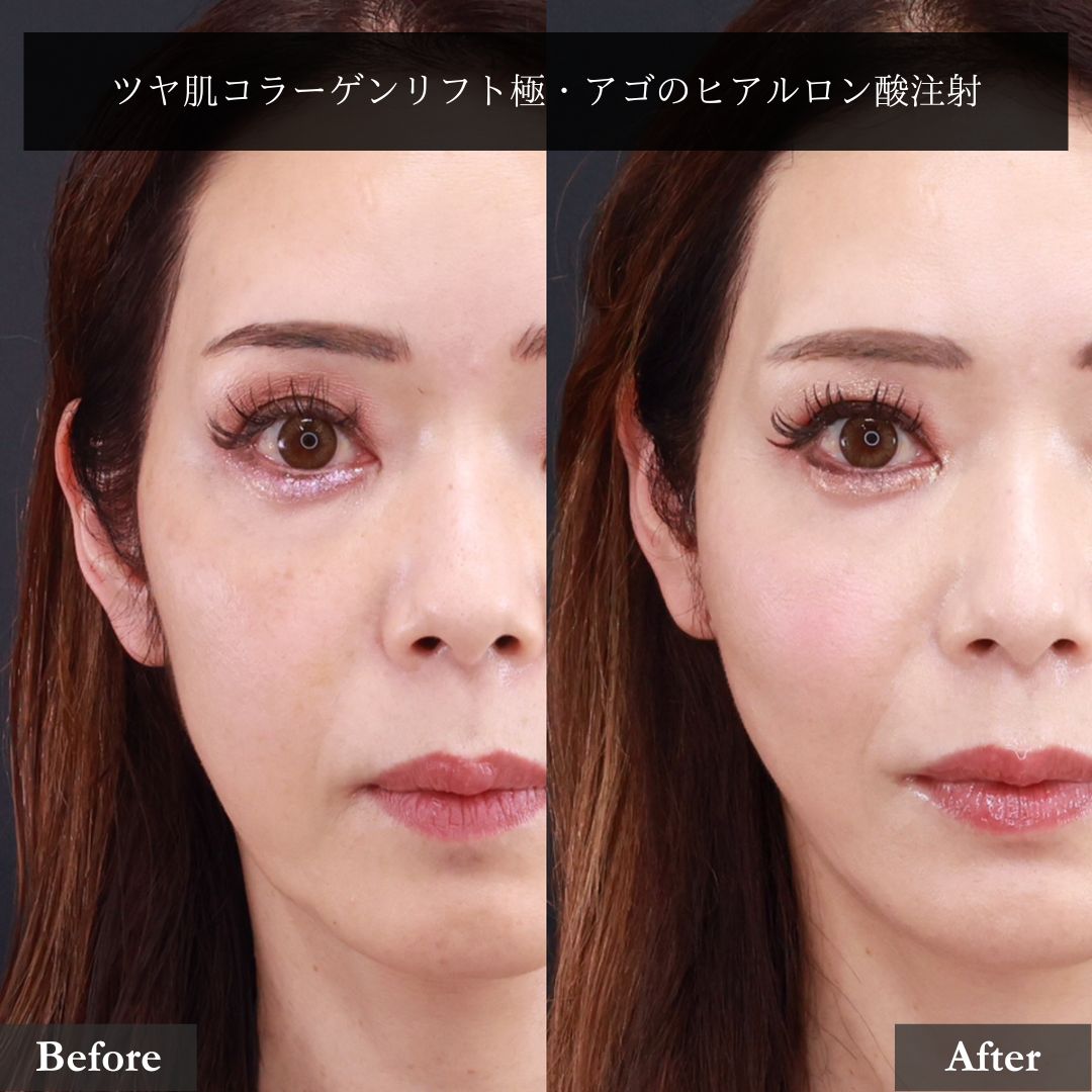 TAC式 ツヤ肌コラーゲンリフト®/顎のヒアルロン酸注射の症例写真 施術前後 