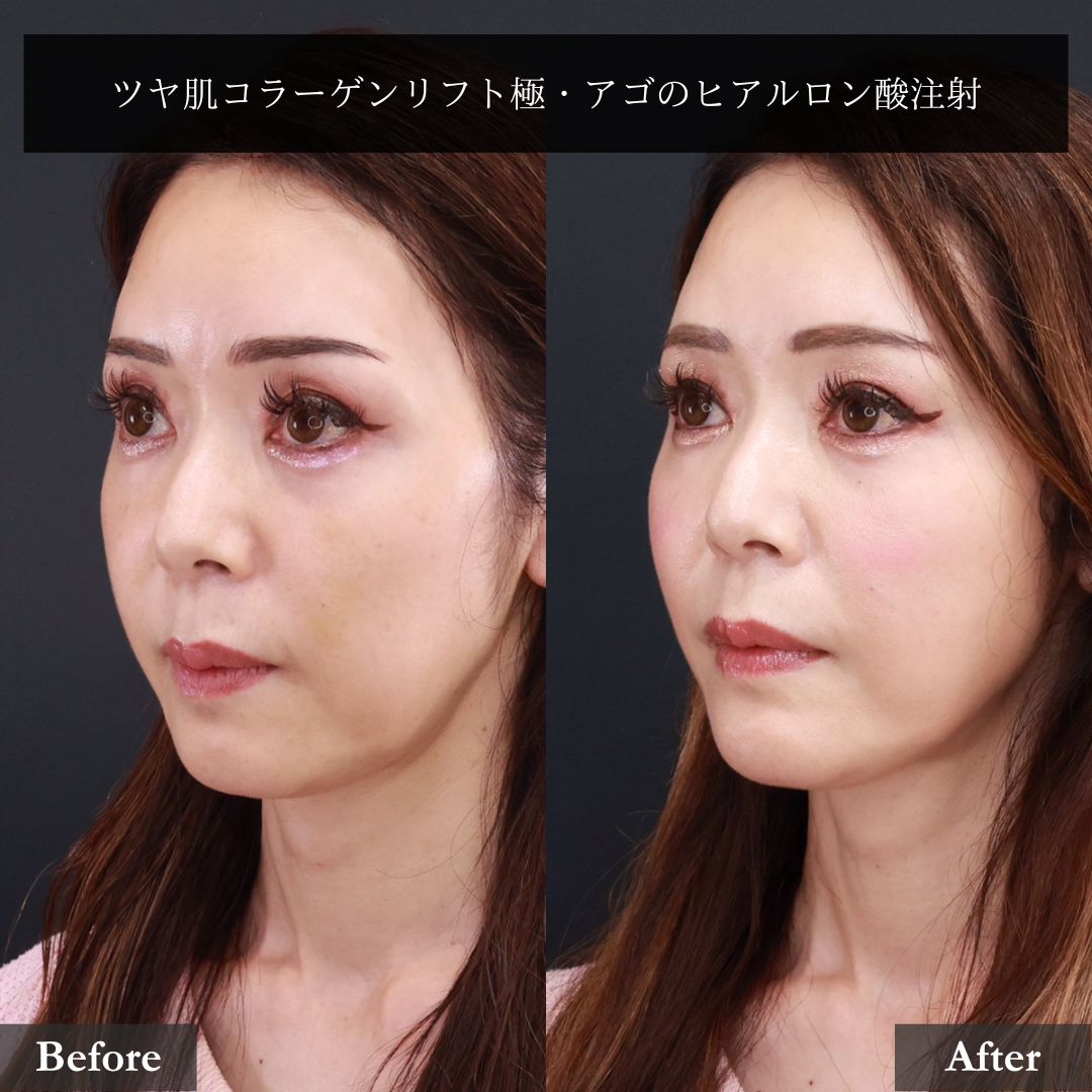 TAC式 ツヤ肌コラーゲンリフト®/顎のヒアルロン酸注射の症例写真 施術前後 