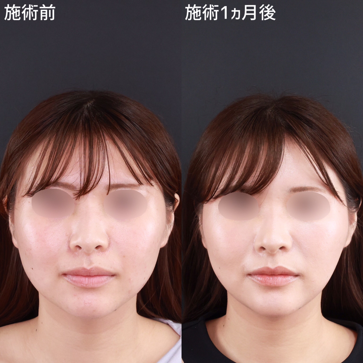 【小顔整形】糸リフトでナチュラルに垢抜け！