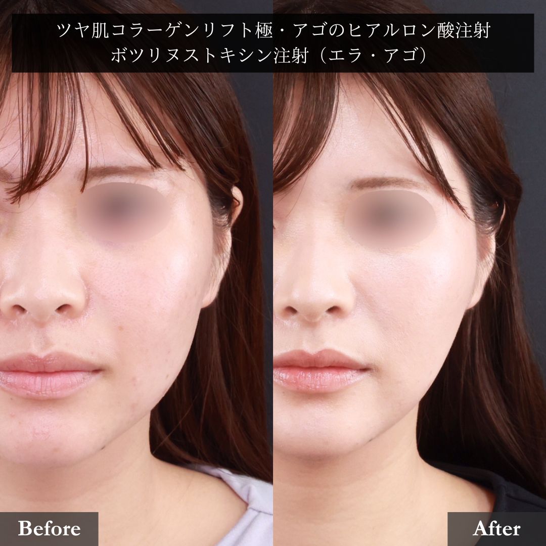 TAC式 ツヤ肌コラーゲンリフト®/エラボトックス注射/ボトックス注射:その他の症例写真 施術前後