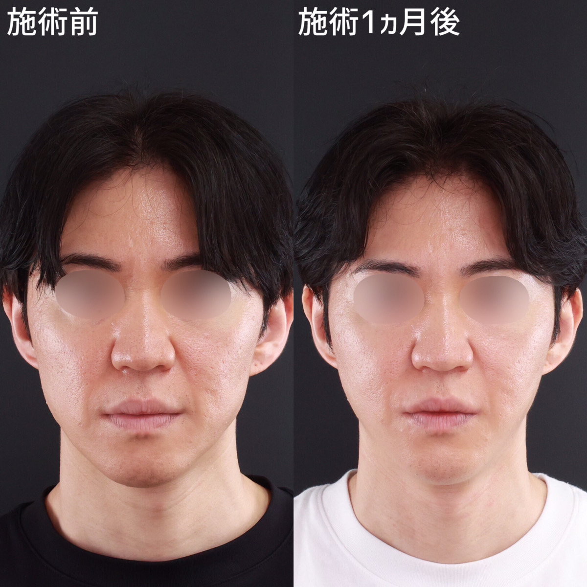 【小顔整形】輪郭を整えて若々しい印象に