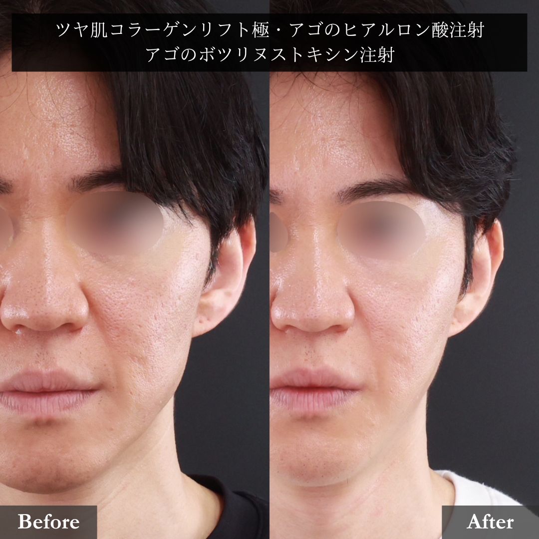 TAC式 ツヤ肌コラーゲンリフト®/顎のヒアルロン酸注射/ボトックス注射：その他の症例写真 施術前後 