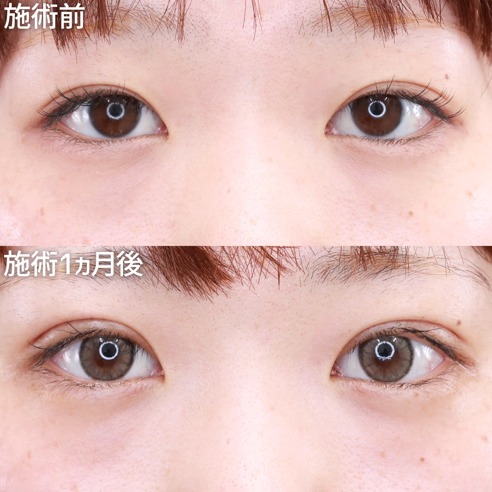 二重切開(全切開法)の症例写真 施術前後