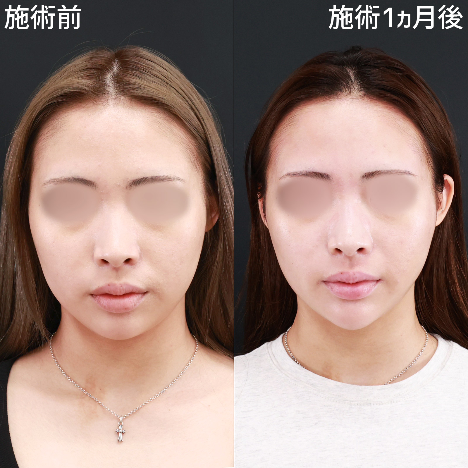 【パーフェクトフェイスライン】口周りをスッキリさせて、アプリ加工級のシャープな輪郭に!