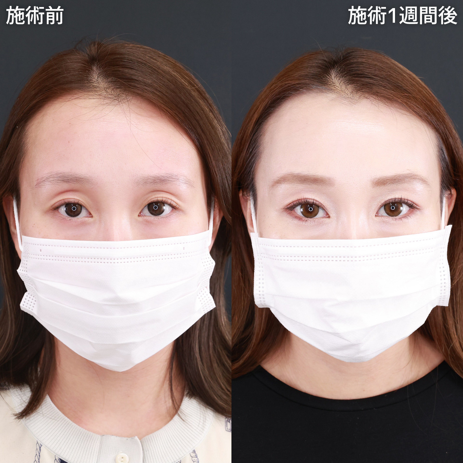 クイックコスメリングの症例写真 施術前後 