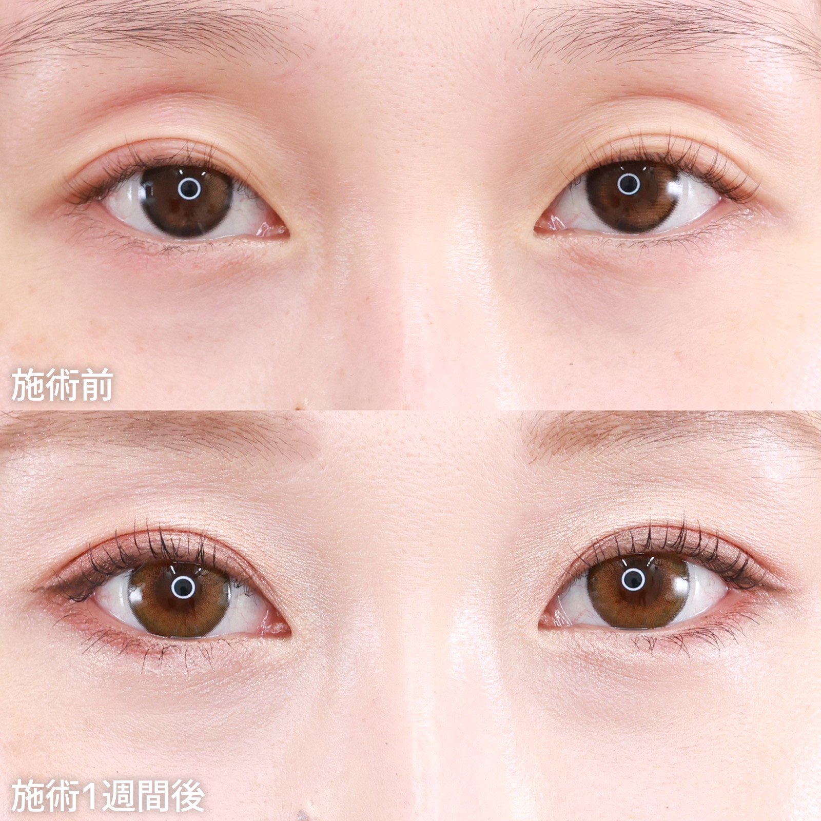 【バレにくい二重整形】窪み目改善！食い込みが弱い二重ラインもクッキリと