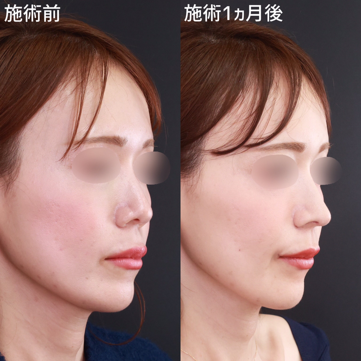 【鼻整形】鼻全体のバランスを整え忘れ鼻へ