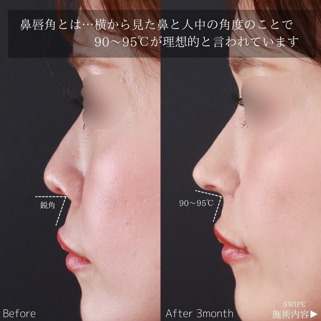 鼻中隔延長術/鼻尖形成・鼻尖縮小/鼻翼挙上術の症例写真 施術前後