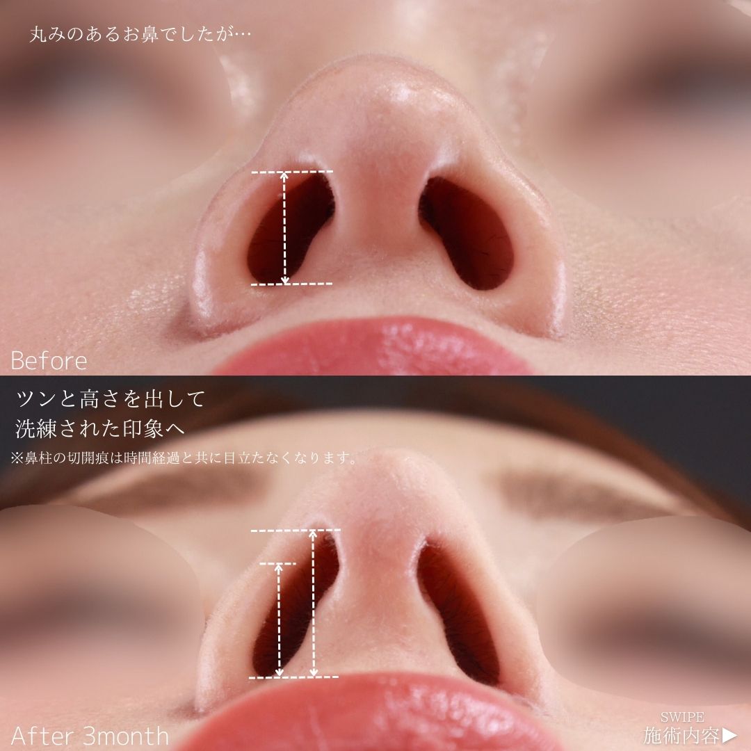 鼻中隔延長術/鼻尖形成・鼻尖縮小/鼻翼挙上術の症例写真 施術前後