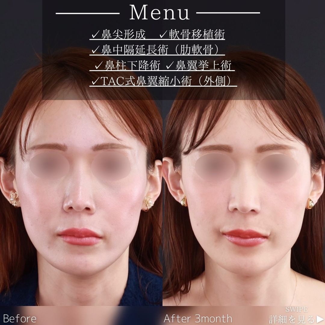 鼻中隔延長術/鼻尖形成・鼻尖縮小/鼻翼挙上術の症例写真 施術前後