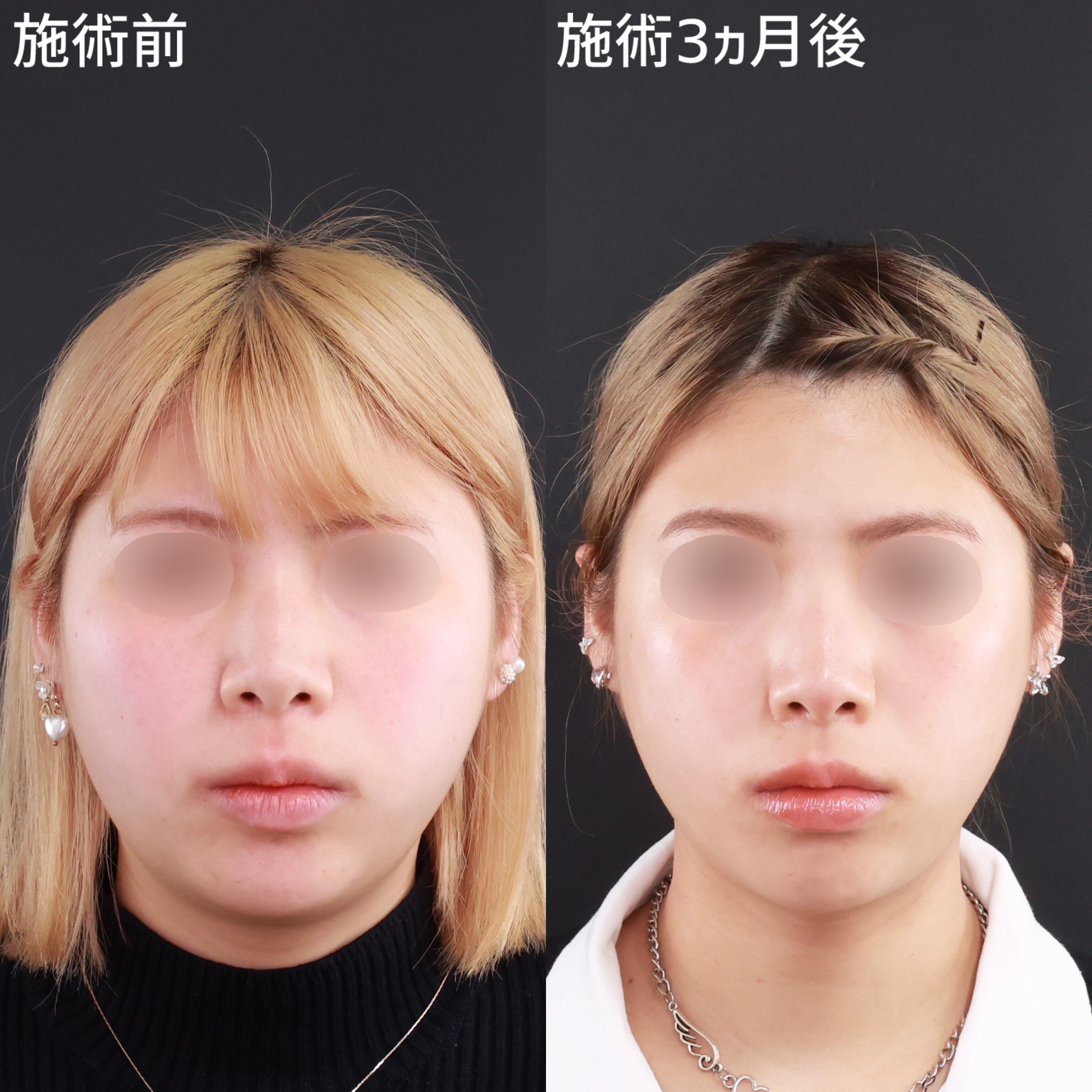 【脂肪吸引】ダイエットではなかなか落ちない二重アゴを解消！