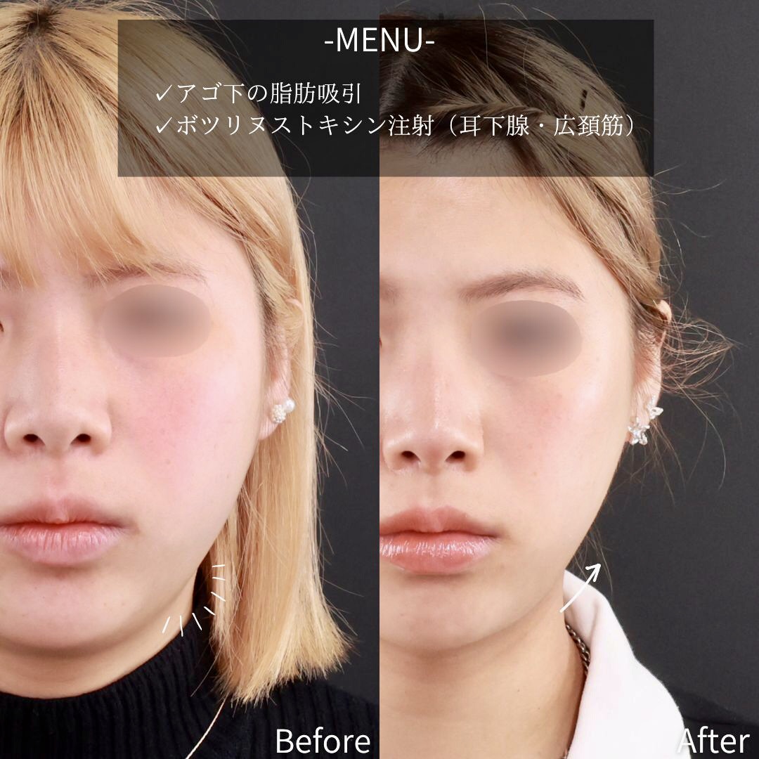 顔の脂肪吸引/ボトックス注射：その他の症例写真 施術前後 