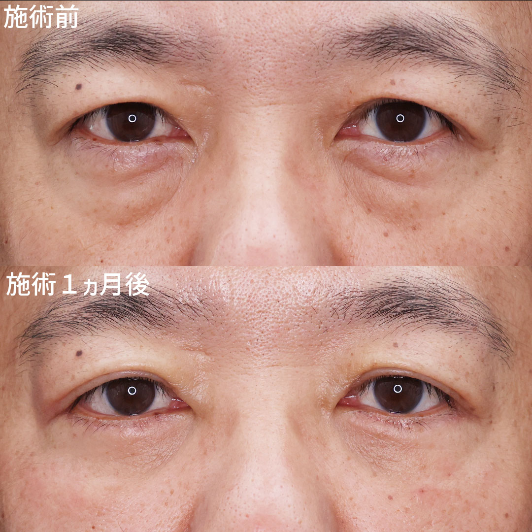 下眼瞼切開術（クマ・たるみとり）の症例写真 施術前後 