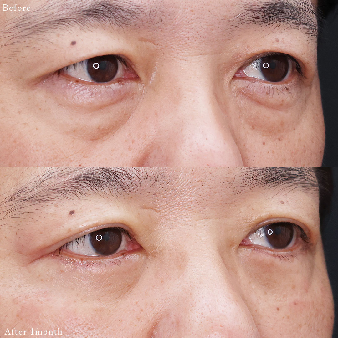 下眼瞼切開術（クマ・たるみとり）の症例写真 施術前後 