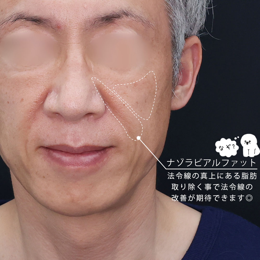 ナゾラビアルファット除去の症例写真 施術前後 