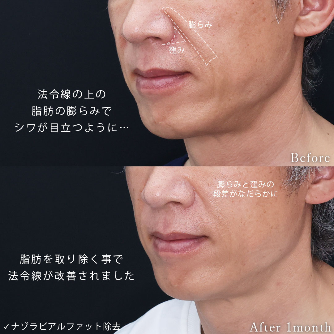 ナゾラビアルファット除去の症例写真 施術前後 