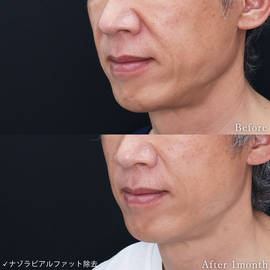 ナゾラビアルファット除去の症例写真 施術前後 