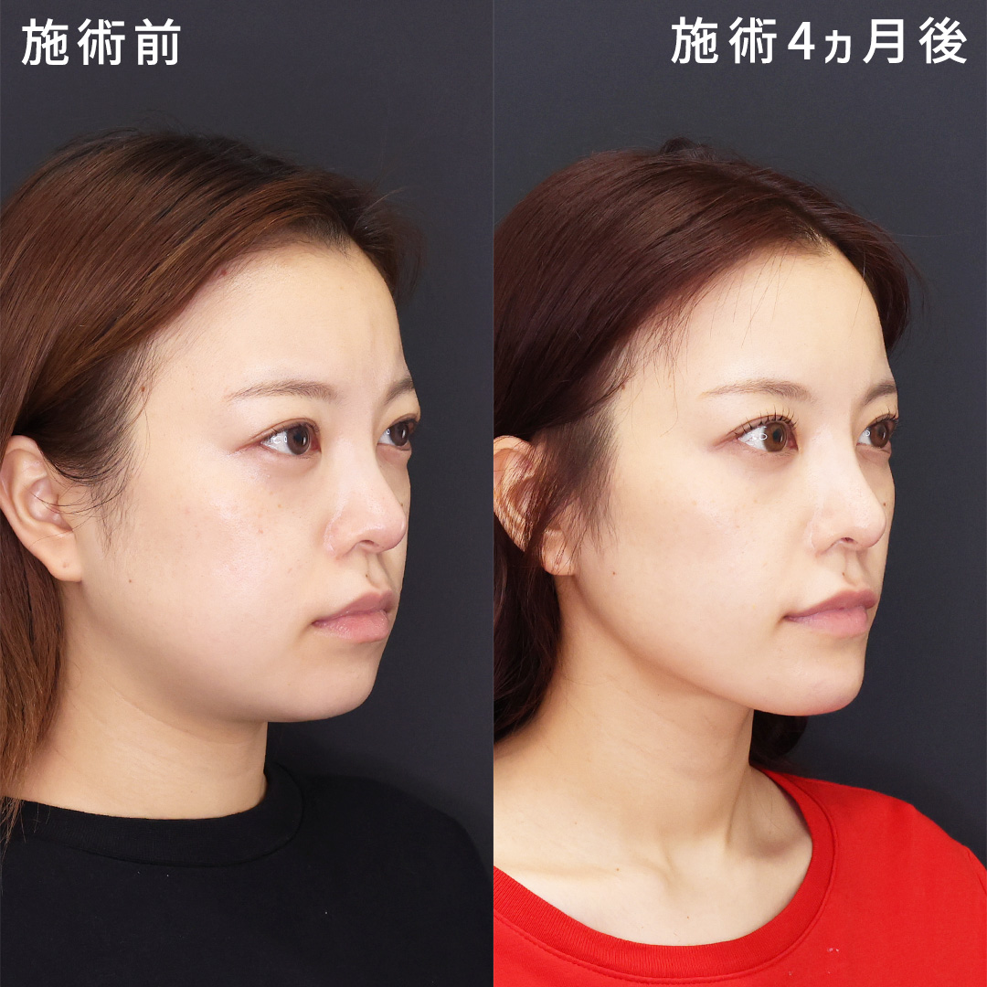 【顔のむくみ感を卒業】脂肪吸引・除去で憧れのスッキリとした印象に