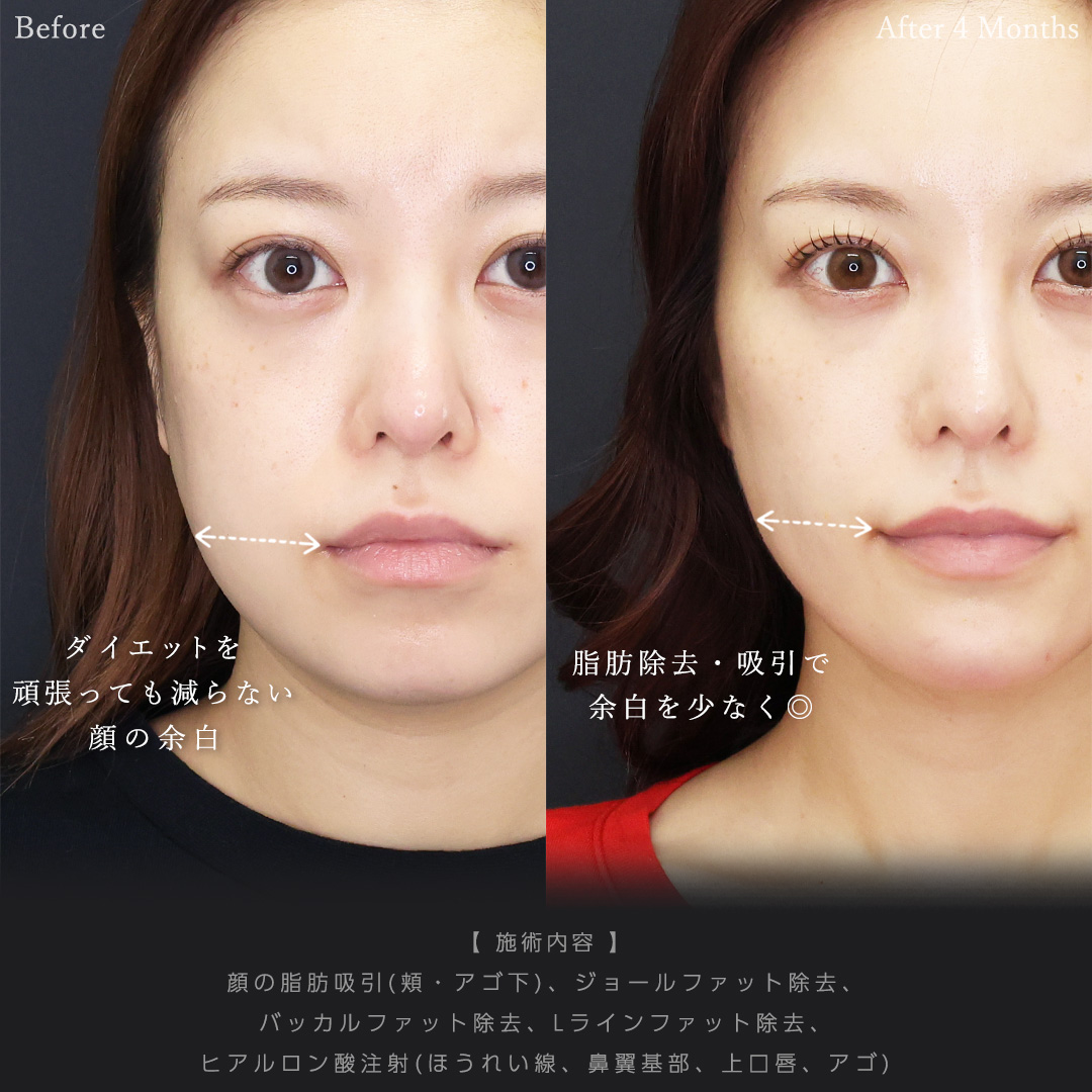 顔の脂肪吸引/ジョールファット除去/バッカルファット除去の症例写真 施術前後 
