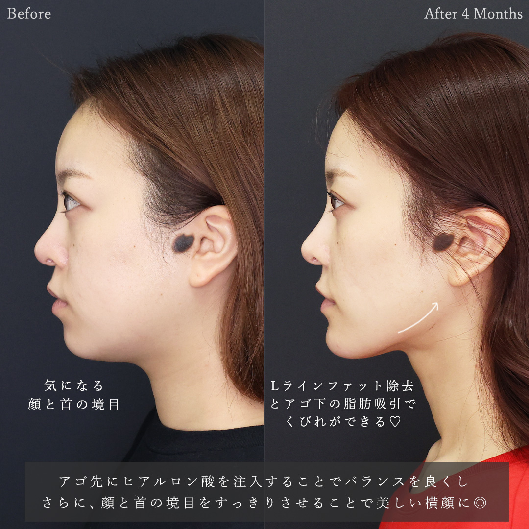 顔の脂肪吸引/ジョールファット除去/バッカルファット除去の症例写真 施術前後 