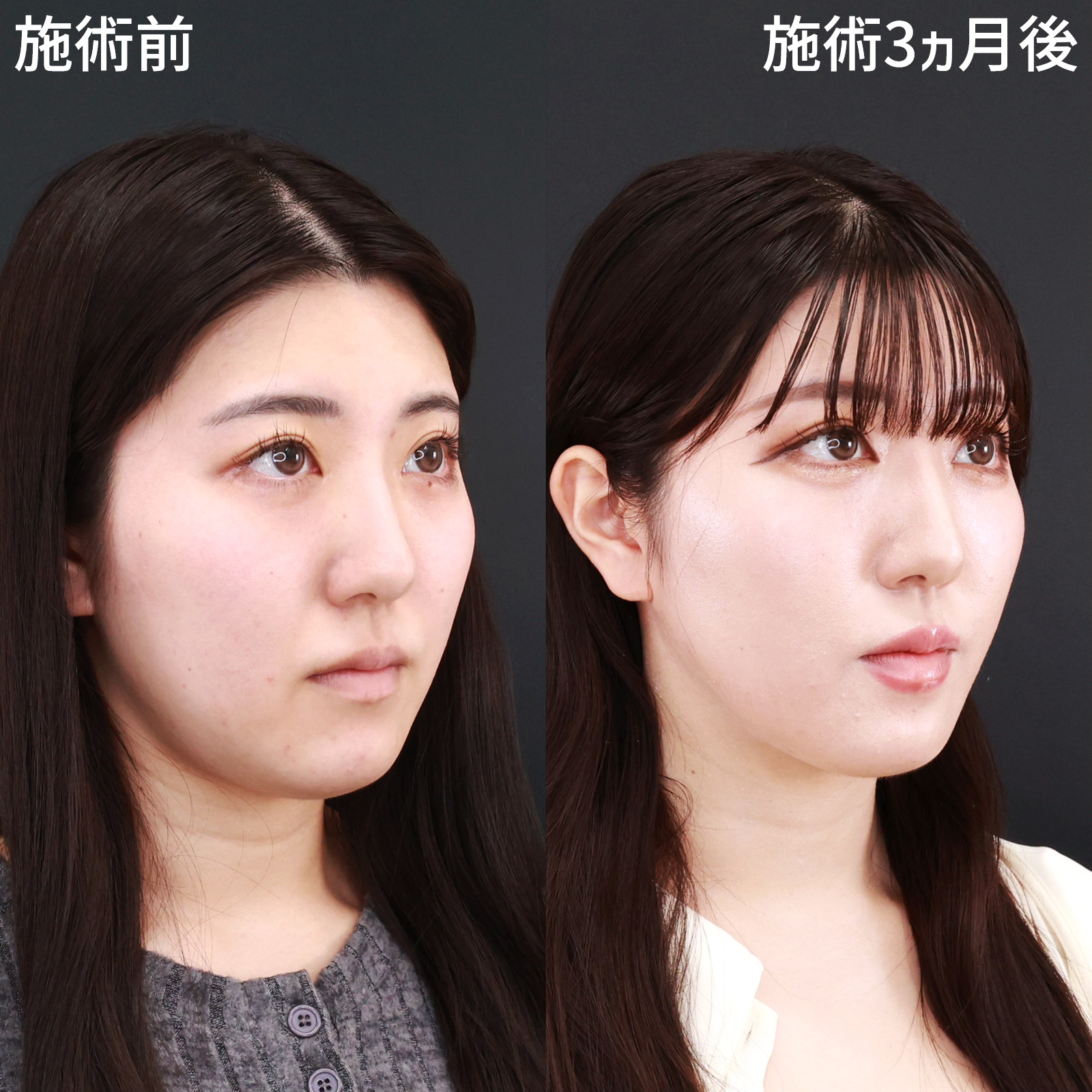 TAC式 ツヤ肌コラーゲンリフト®/顎下の脂肪吸引/ジョールファット除去の症例写真 施術前後 