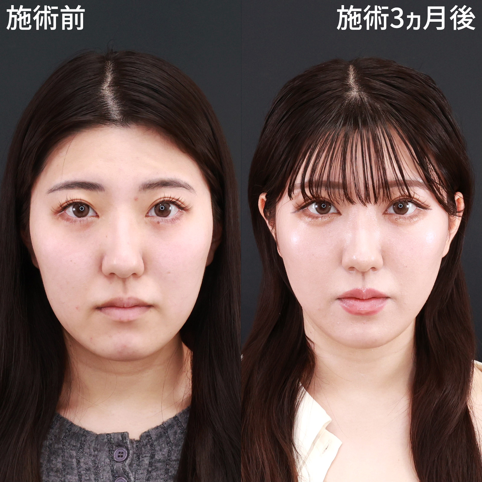 【糸リフト＆脂肪吸引】間延びした印象を改善！より若々しいお顔立ちに