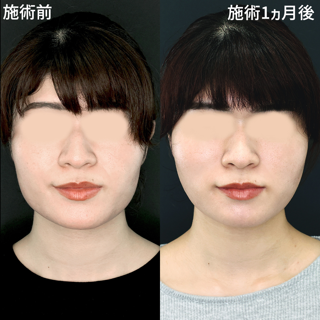 「糸リフトとエラのボトックス注射」で憧れの卵型フェイスラインに