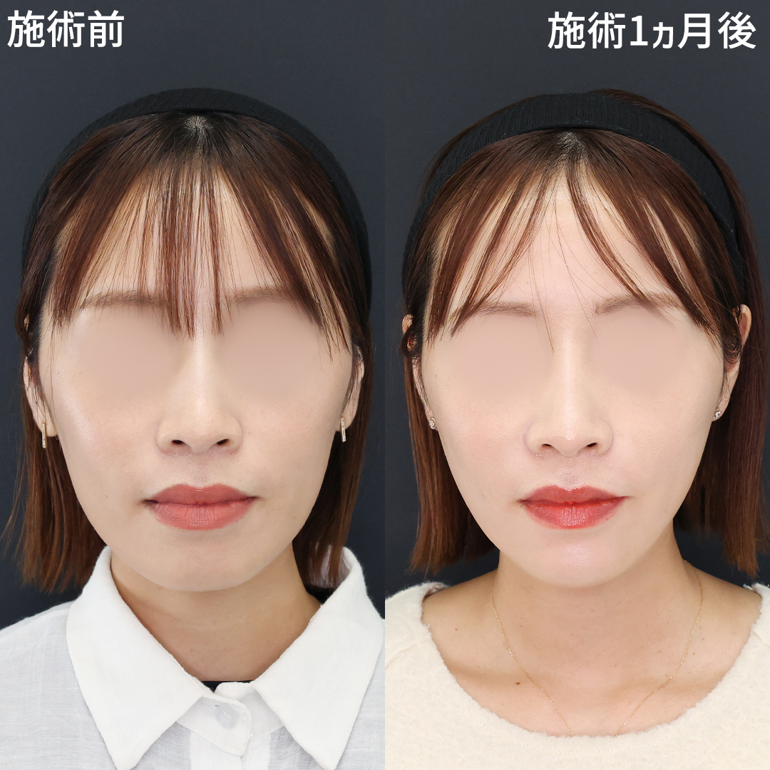 「ボトックス注射」でエラ張りを解消！美しいフェイスラインに