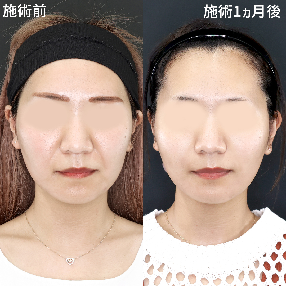 TAC式 ツヤ肌コラーゲンリフト®/ほうれい線のヒアルロン酸注射の症例写真 施術前後