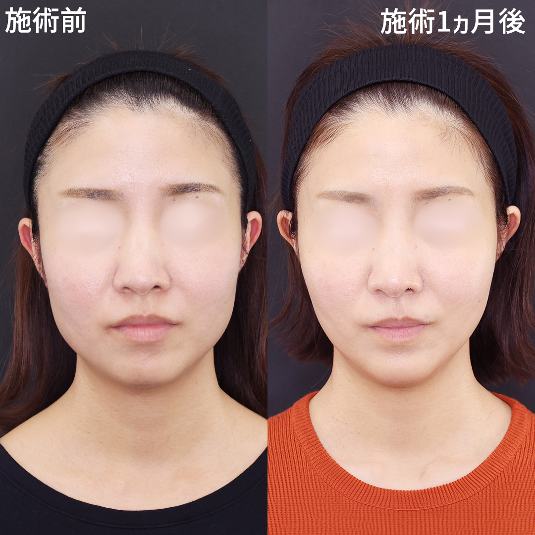 「糸リフトとボツリヌストキシン注射」でお顔のサイズダウンを実現