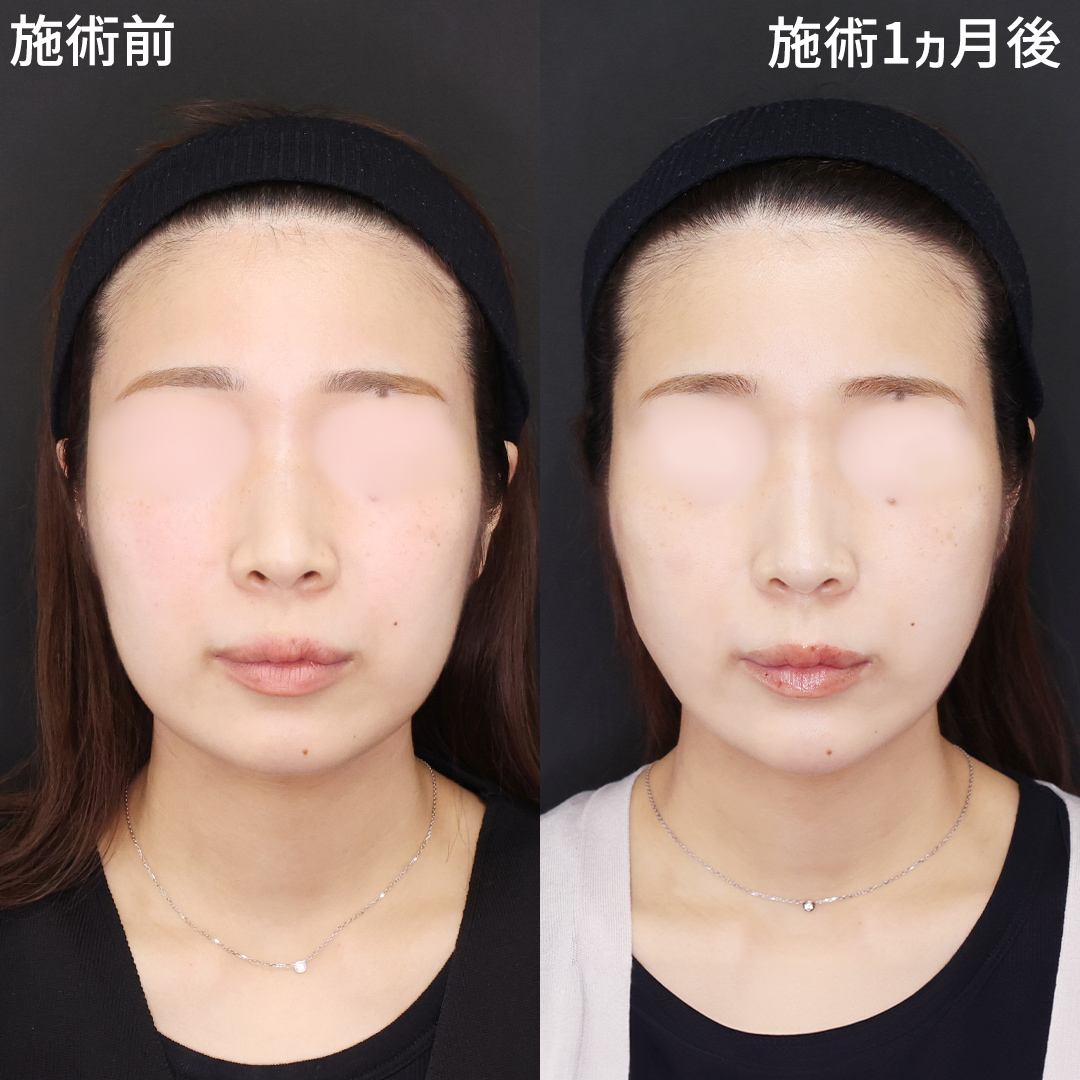 「糸リフトと脂肪除去（Lラインファット除去®）」で洗練されたフェイスラインに