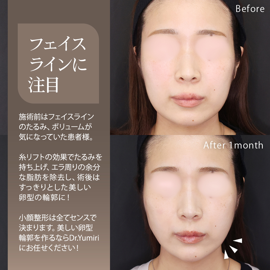 TAC式 ツヤ肌コラーゲンリフト®/Lラインファット除去（エラ下脂肪除去）/エラボトックス注射の症例写真 施術前後 