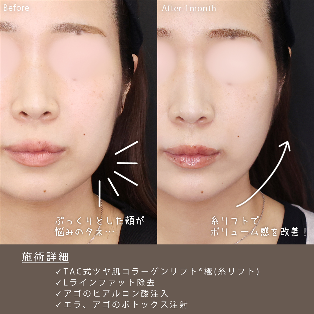 TAC式 ツヤ肌コラーゲンリフト®/Lラインファット除去（エラ下脂肪除去）/エラボトックス注射の症例写真 施術前後 