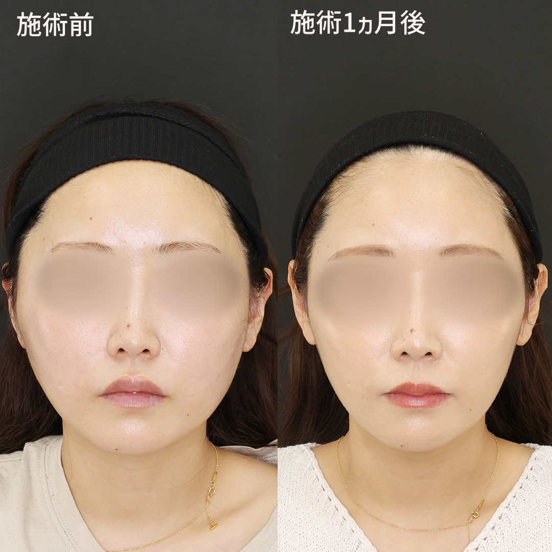 【骨切りなしで輪郭改善】憧れの卵型輪郭！