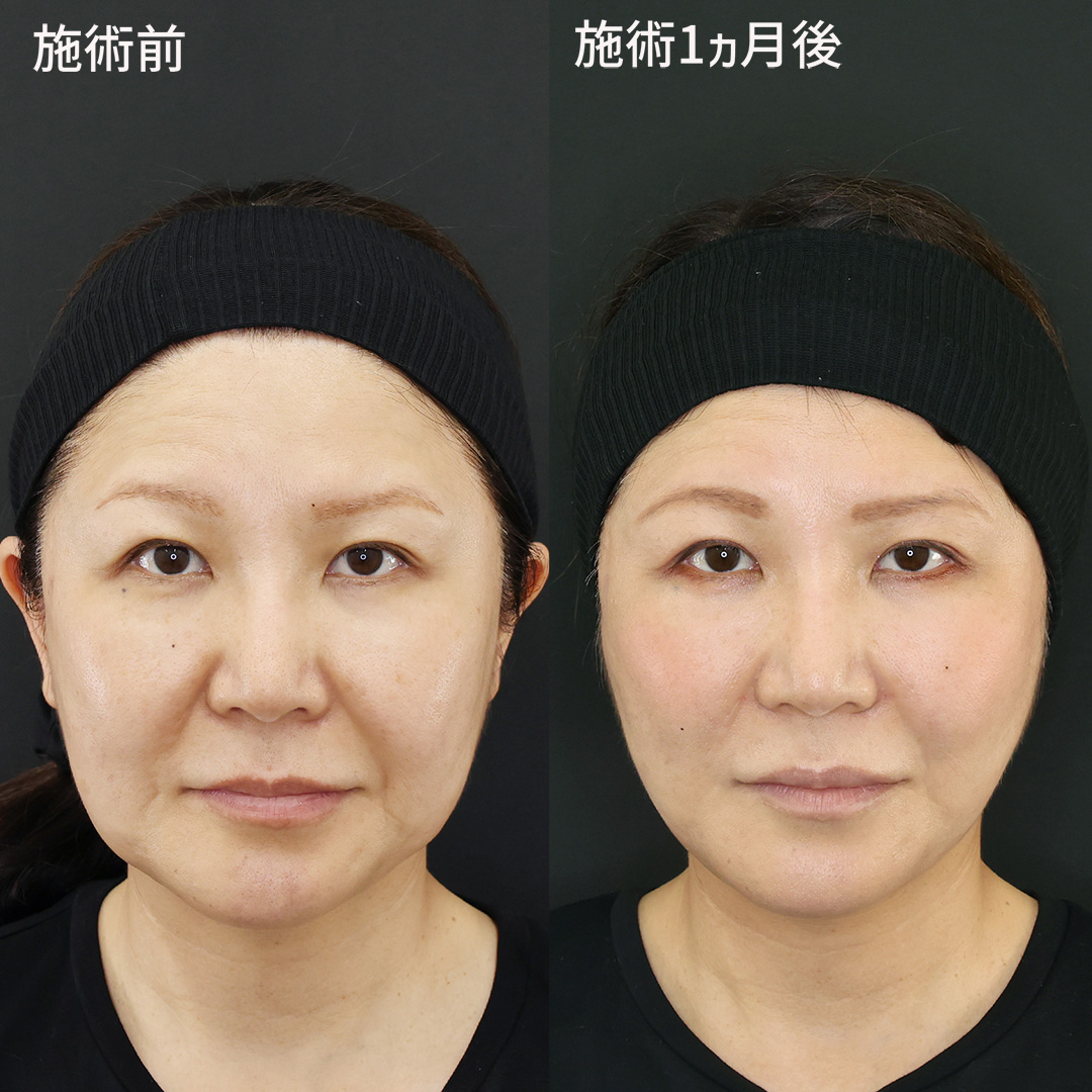 【若返り小顔術】切らず削らず輪郭を整える