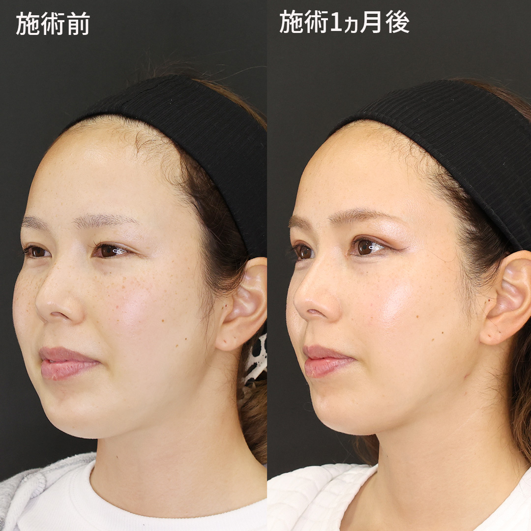 TAC式 ツヤ肌コラーゲンリフト®/バッカルファット除去/Lラインファット除去（エラ下脂肪除去）の症例写真 施術前後 