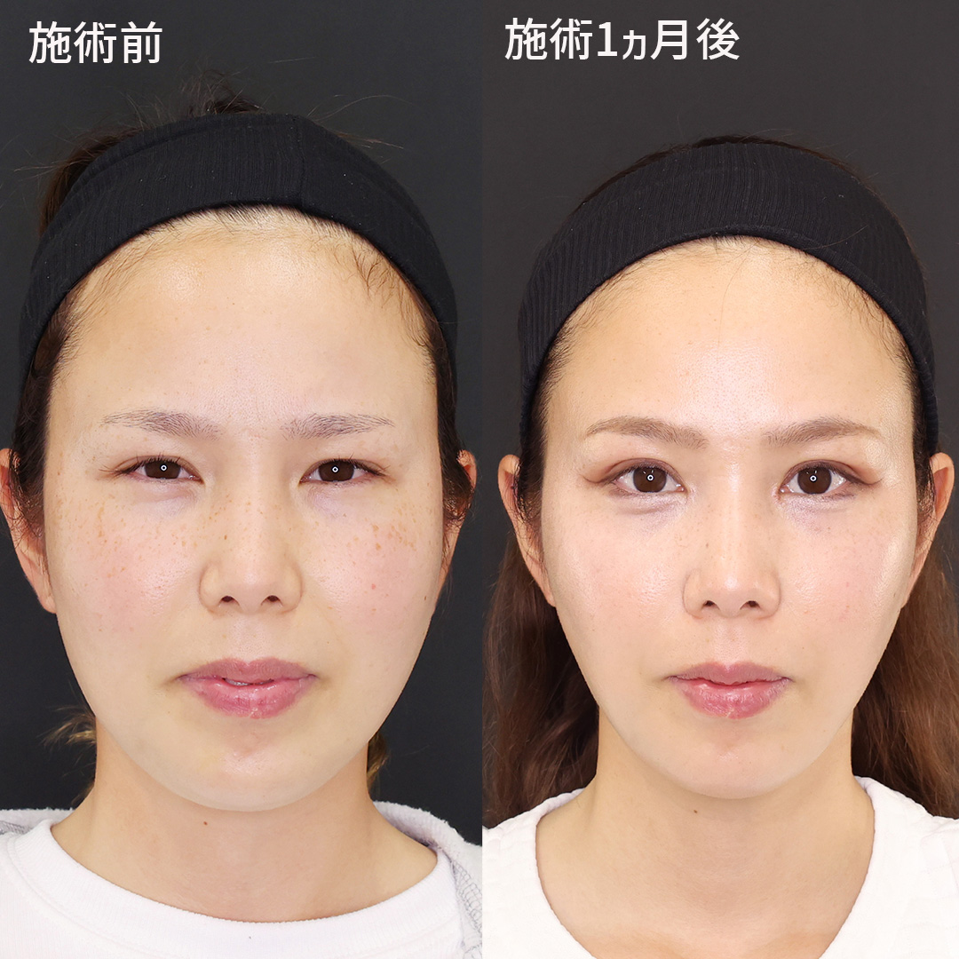 【糸リフト×脂肪吸引】美を極める小顔術