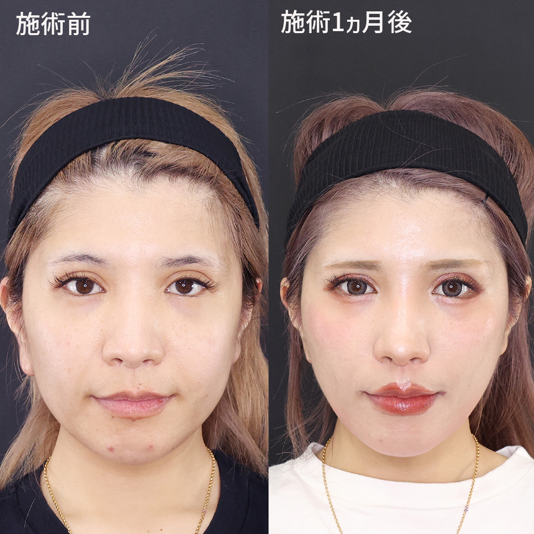 【糸リフトのみでここまで変化！】憧れの卵型輪郭