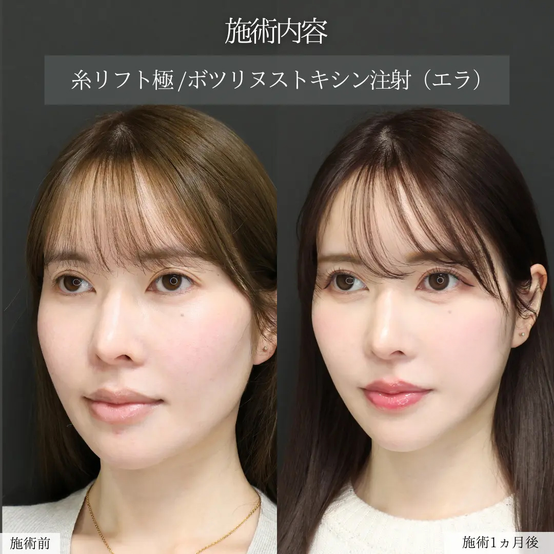 TAC式 ツヤ肌コラーゲンリフト®/エラボトックス注射の症例写真 施術前後 