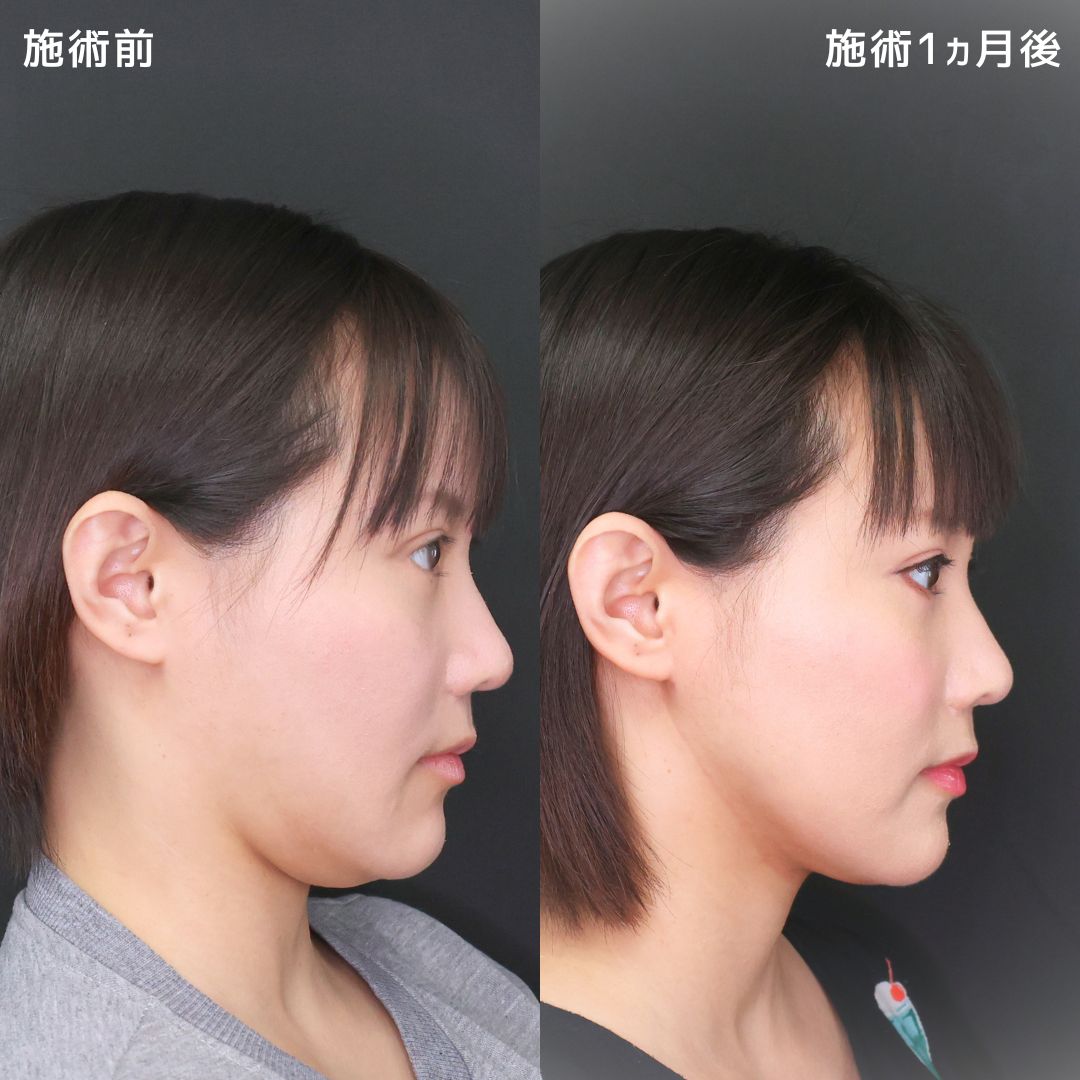 《脂肪吸引》すっきりフェイスライン