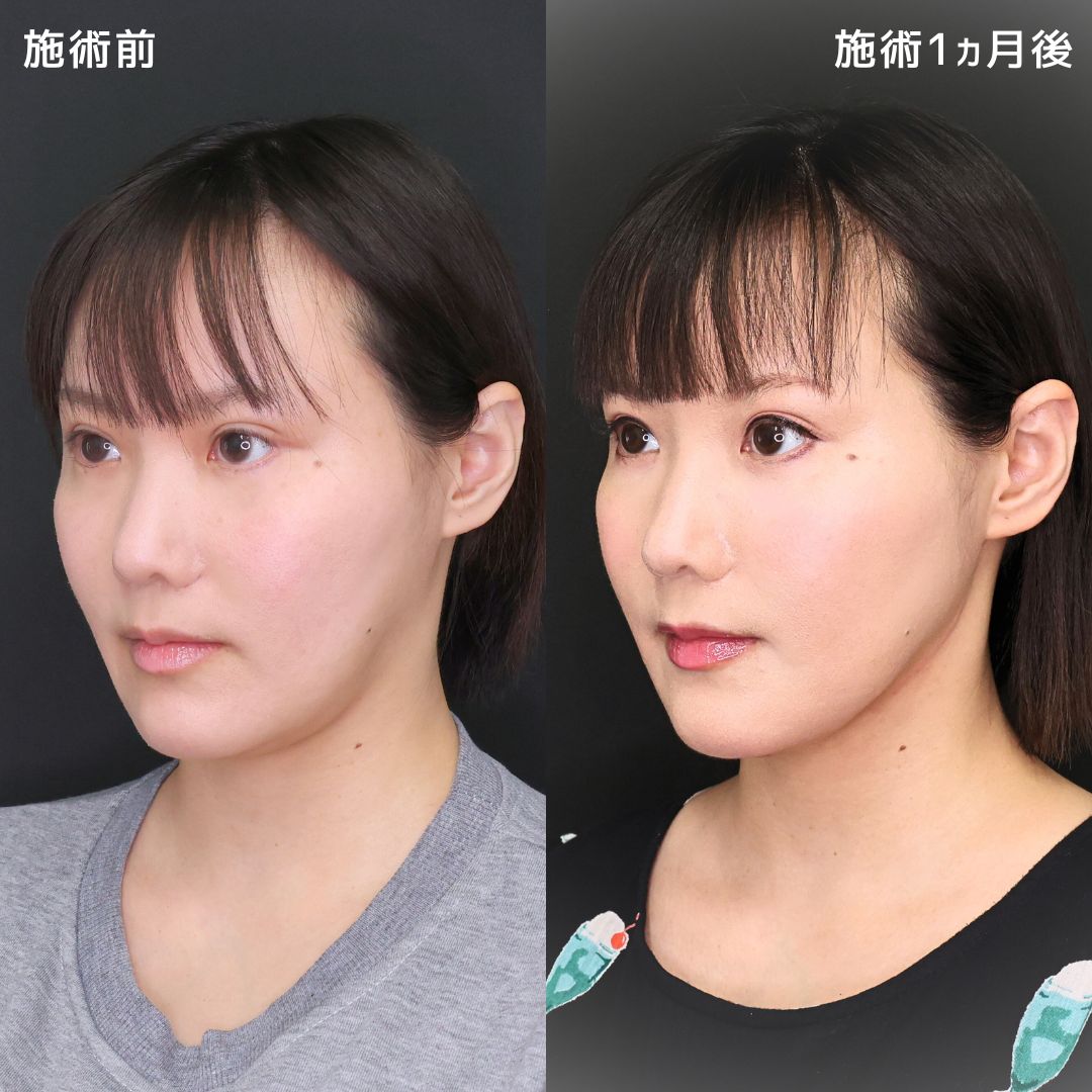 TAC式 ツヤ肌コラーゲンリフト®/Lラインファット除去（エラ下脂肪除去）/顎下の脂肪吸引の症例写真 施術前後 