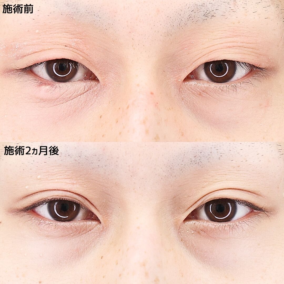 《男性の埋没法》憧れの平行二重でイケメンに