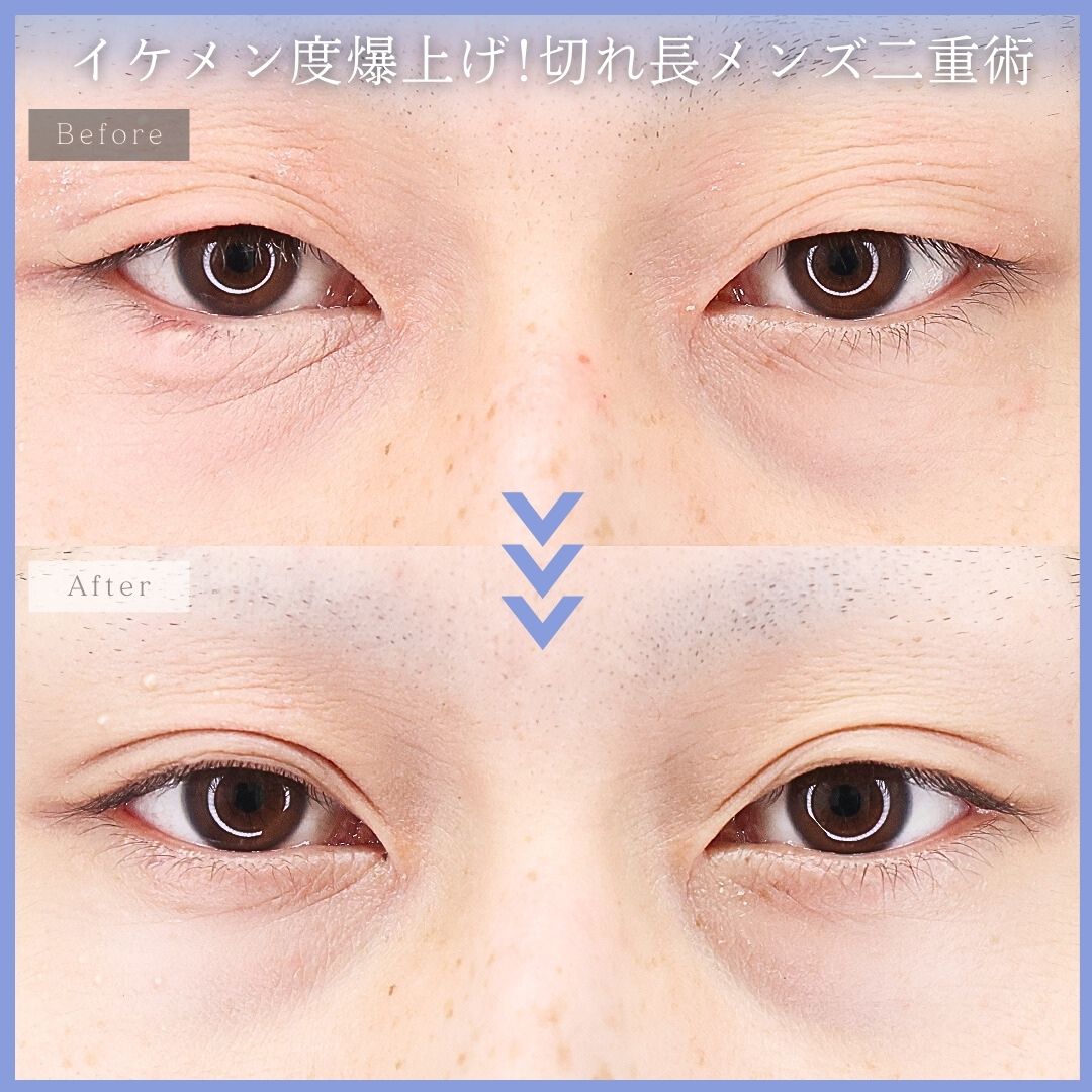 二重埋没法の症例写真 施術前後 