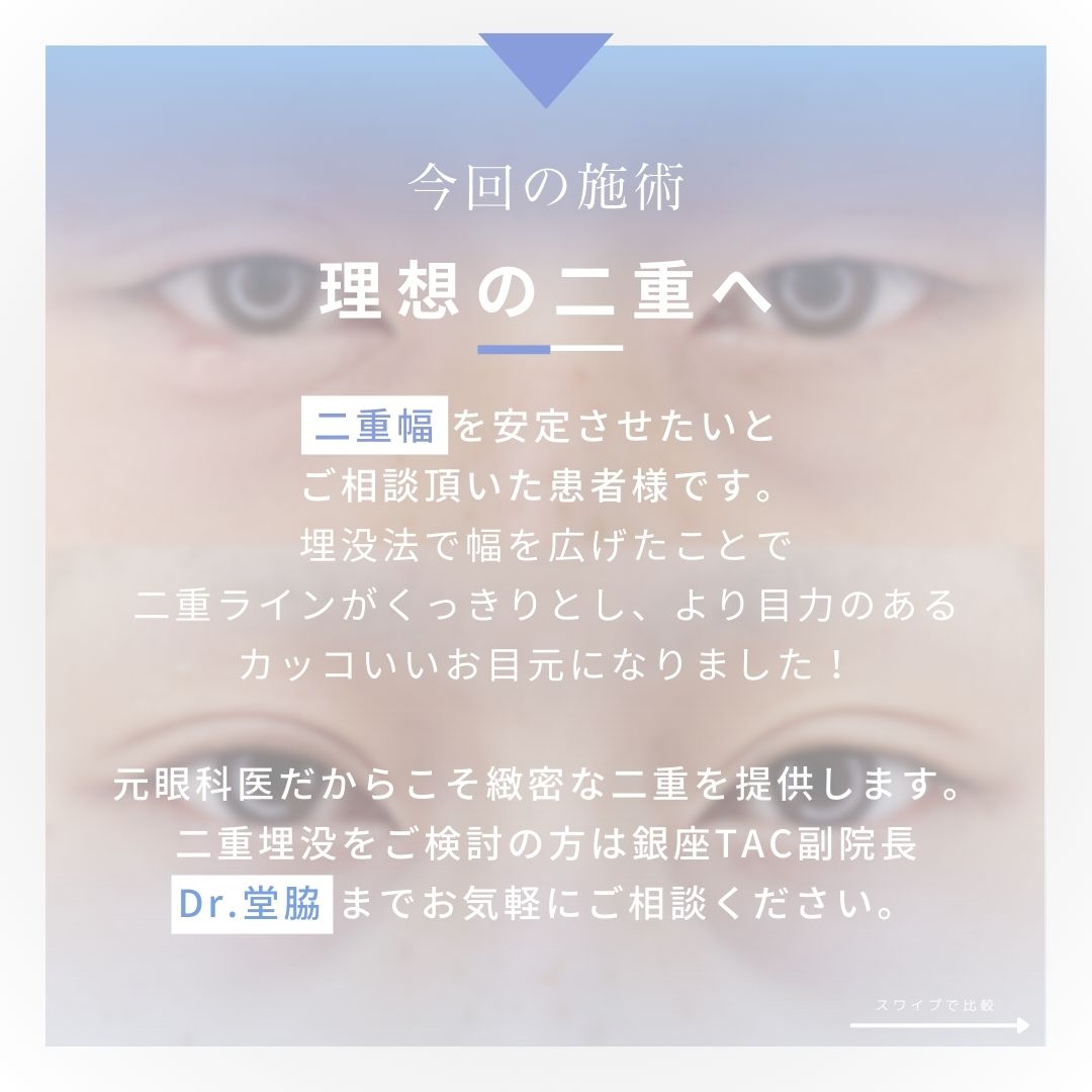 二重埋没法の症例写真 施術前後 