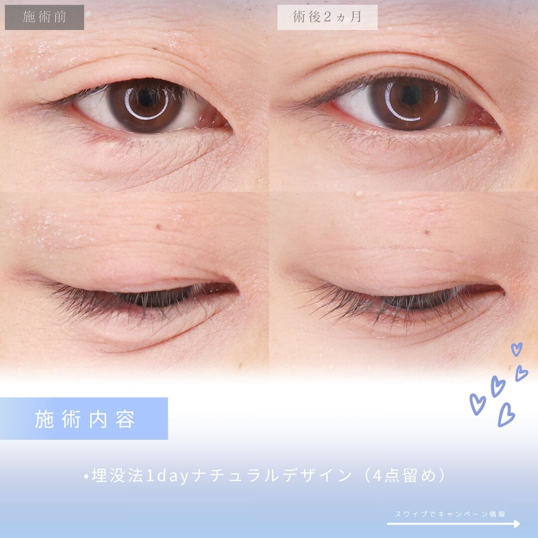 二重埋没法の症例写真 施術前後 