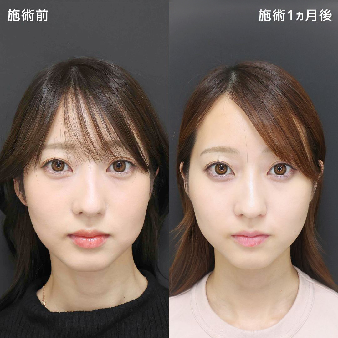 TAC式 ツヤ肌コラーゲンリフト®/ボトックス注射:その他の症例写真 施術前後