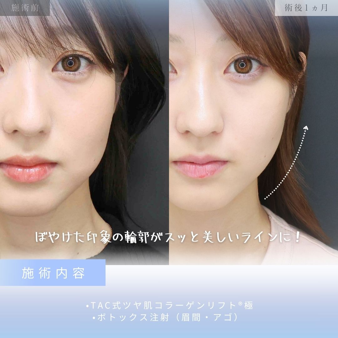 TAC式 ツヤ肌コラーゲンリフト®/ボトックス注射:その他の症例写真 施術前後