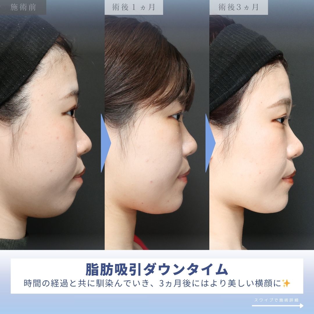 TAC式 ツヤ肌コラーゲンリフト®/ジョールファット除去/Lラインファット除去(エラ下脂肪除去)の症例写真 施術前後
