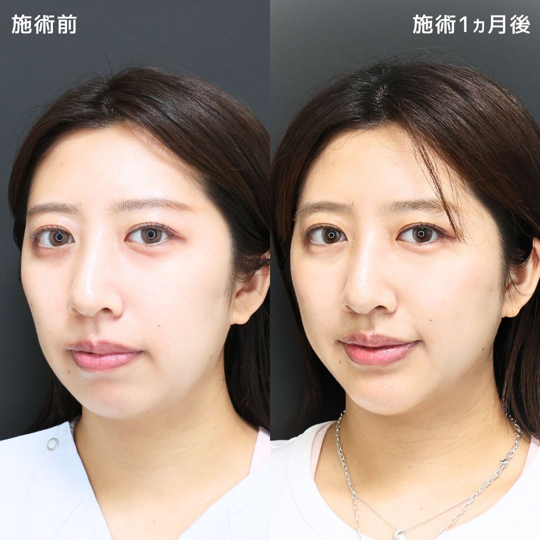TAC式 ツヤ肌コラーゲンリフト®/ジョールファット除去/Lラインファット除去（エラ下脂肪除去）の症例写真 施術前後 